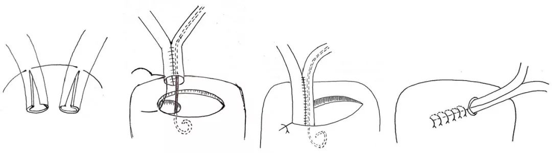 一个肾脏两条输尿管？这类肾移植该怎么做？|手术图解
