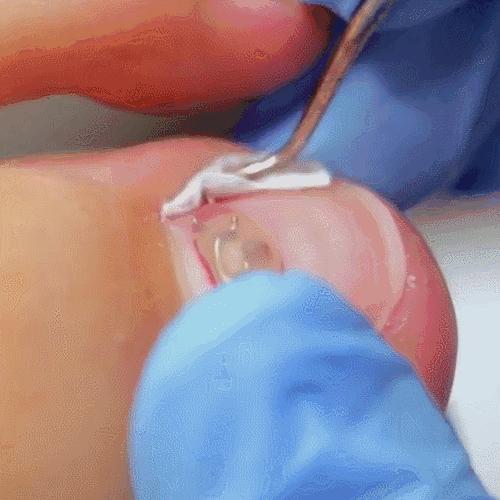 怎么治疗灰趾甲才能彻底不反复,如何快速自然地摆脱指甲真菌