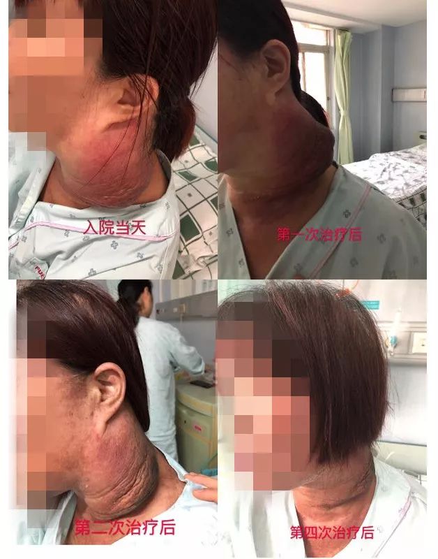 鼻咽癌脖子肿瘤太大还能治好吗,鼻咽癌转移颈部淋巴能彻底治好吗