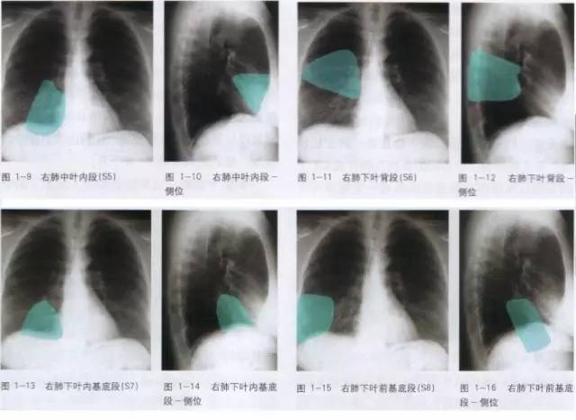 胸部ct解剖结构,胸部x线解读视频