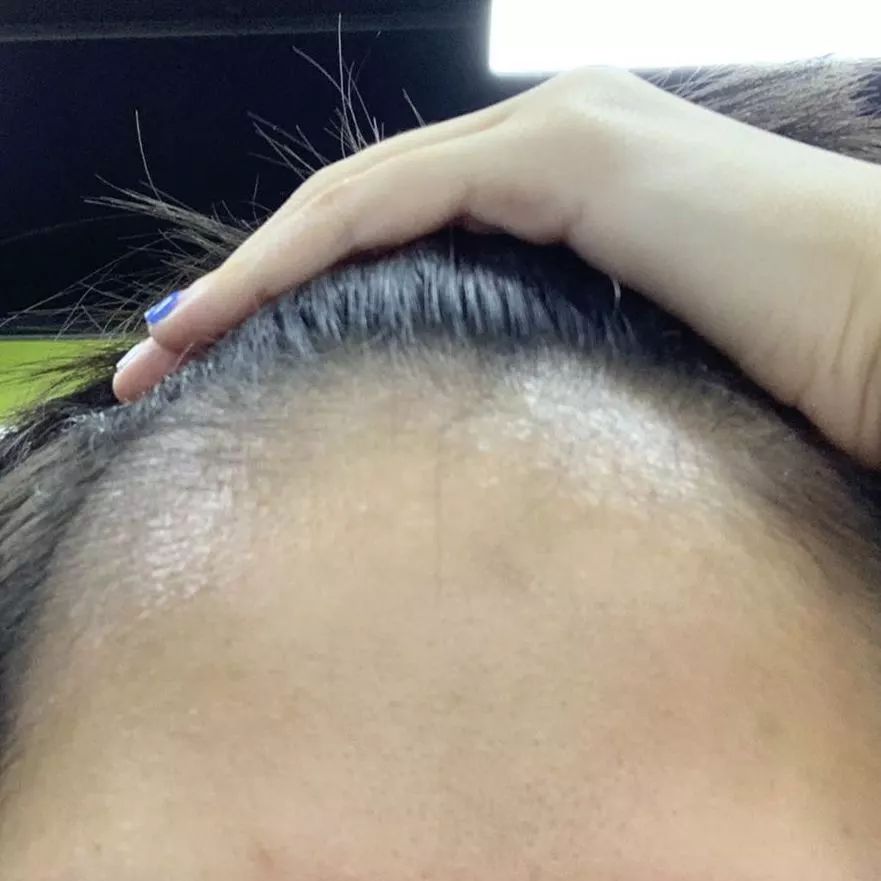 断货王祛痘胶囊,秒杀祛痘化妆品一元