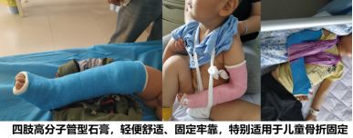 孩子手骨折如何提醒大家注意,小朋友骨折的预防