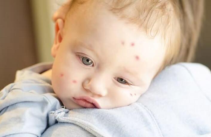蚊子咬的红点一直不消怎么回事,新生儿蚊子咬的红点怎么去除