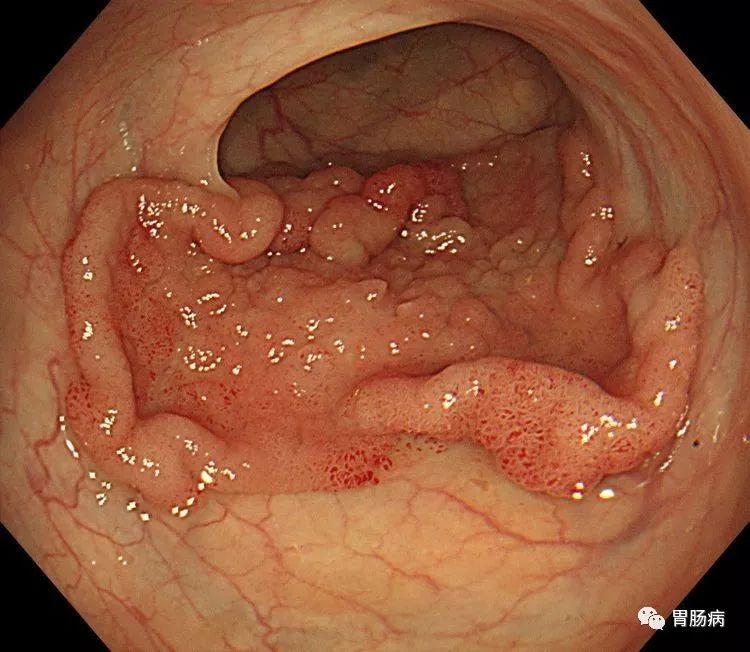 全面解读：结直肠息肉