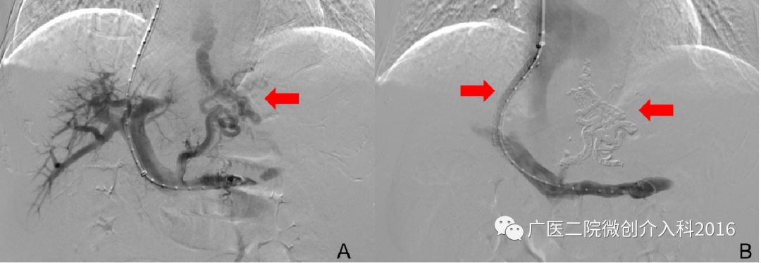 出现了吐血吃什么药,吐血又便血是什么病的征兆