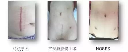 胃肠外科微创手术,微创融合和微创双通道