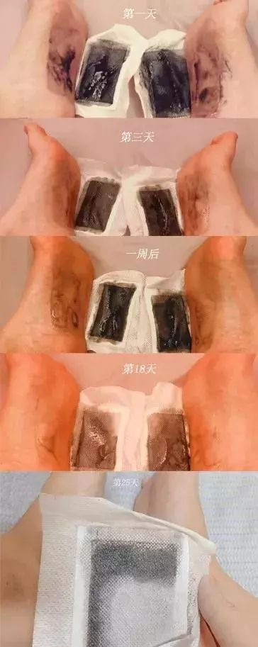 湿气重做什么动作可以排湿,湿气重吃什么药可以快速排湿