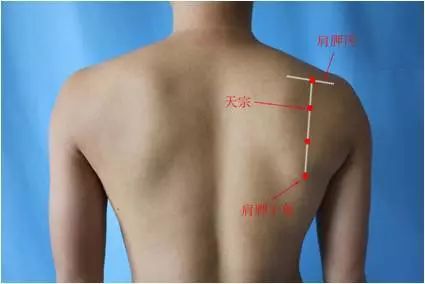 肩周炎讨人嫌，轻轻一灸治疗解烦忧