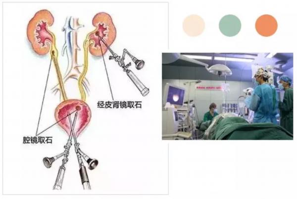 东营市二院泌尿外科成立了个尿结石防治中心