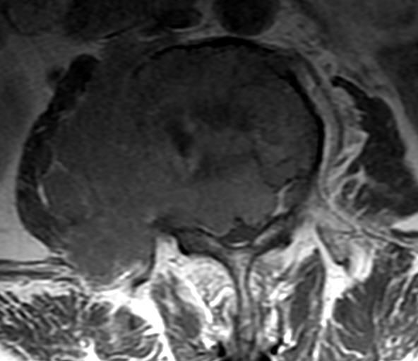 一分钟带你了解腰椎狭窄,椎管狭窄症知识大全