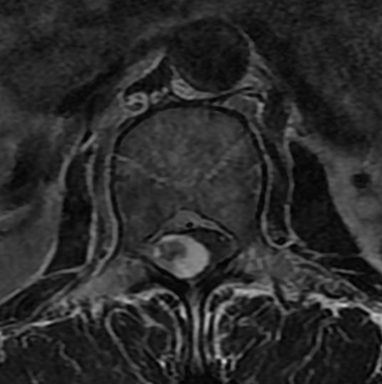 一分钟带你了解腰椎狭窄,椎管狭窄症知识大全