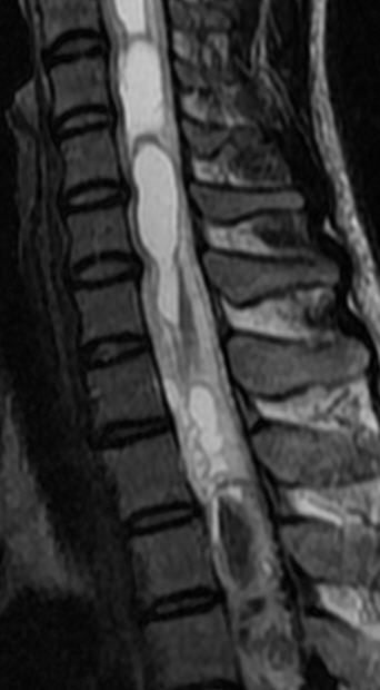 一分钟带你了解腰椎狭窄,椎管狭窄症知识大全