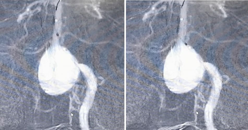 椎动脉夹层动脉瘤的最佳治疗方法,椎基底动脉夹层动脉瘤治疗方法