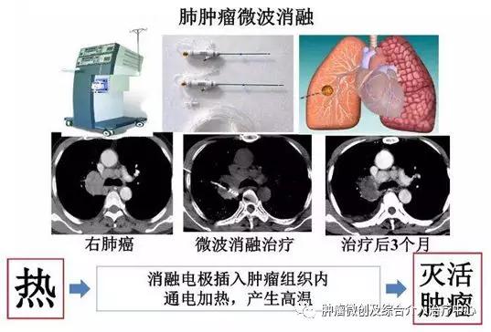咯血介入治疗后还要止血药吗,肺部大咯血的介入栓塞治疗