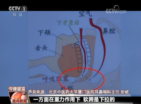 男子打鼾一夜断气576次,打鼾导致呼吸停止致死