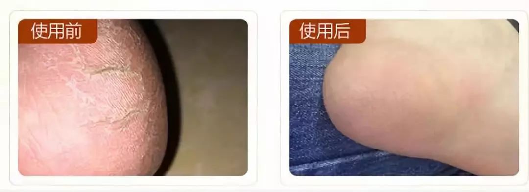 治脚气干裂起皮用什么药膏,有这个方子来治脚气就不怕复发