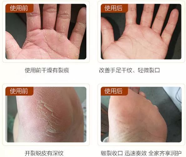 治脚气的抗真菌偏方,角化型脚气干裂最好的药