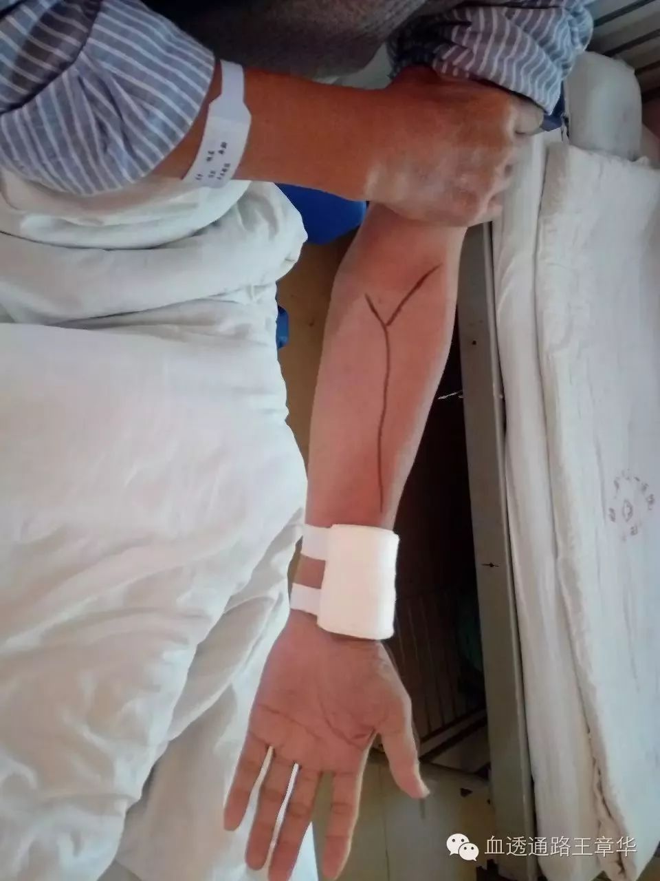 自体动静脉内瘘术后护理,自体动静脉内瘘术后2周锻炼方法