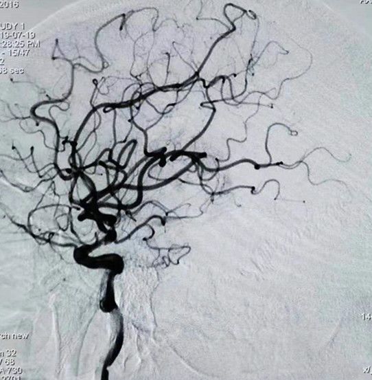 Reco特约·第10期｜国产组合助力取栓“一把通”——Ewata球囊导引导管联合Reco支架取栓分享