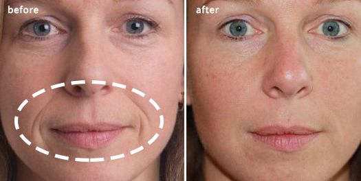 眉间纹和法令纹除皱针能去掉吗,嘴角纹法令纹抬头纹国货推荐