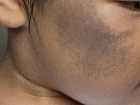 宝宝出生有乌青怎么回事,宝宝出生屁屁上都有淤青吗