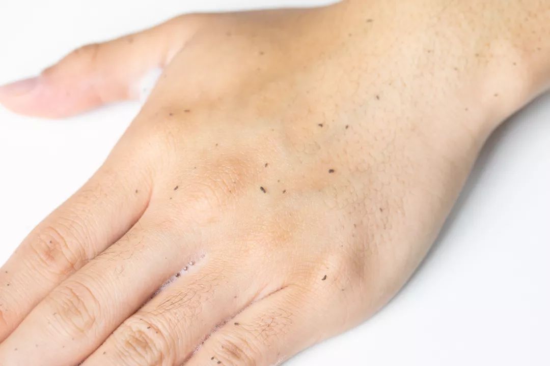 男士清理螨虫和黑头机器,男生青春痘黑头清洁神器