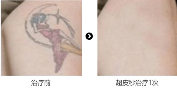 ‘斑’弄是非，超皮秒要你好看