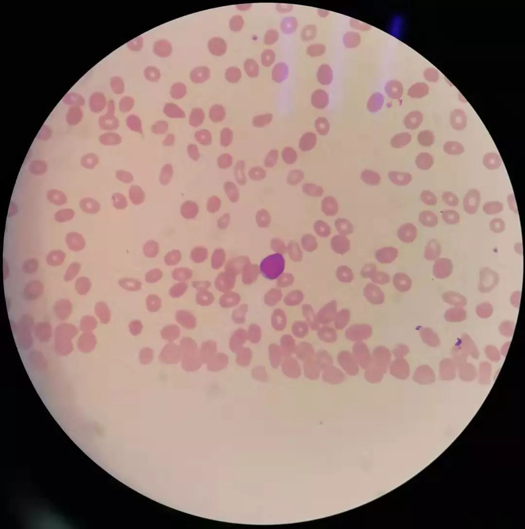 全血细胞减少就是白血病,全血细胞减少性白血病