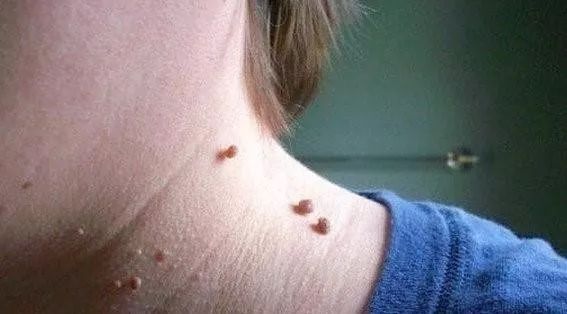 为什么脸上的痘痘那么难消,你脸上的痘痘是螨虫痘吗