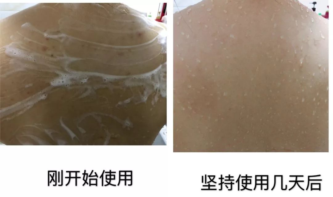 可美金箔祛痘螨虫皂,除螨皂能祛螨虫吗