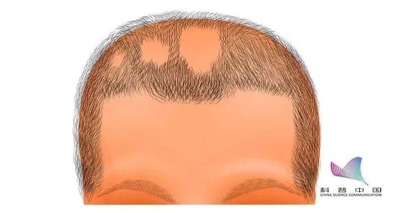 鬼剃头是怎么造成的,鬼剃头的原因及解决方法