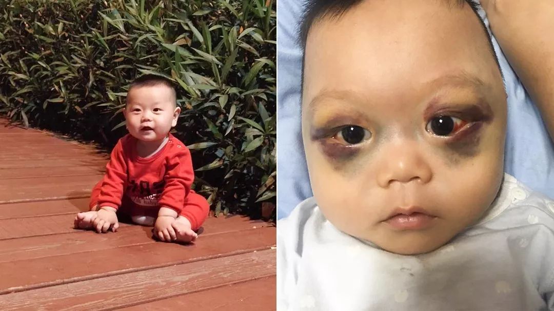 小男孩双眼淤青肿胀，酷似熊猫眼，父母曾被人怀疑虐待孩子