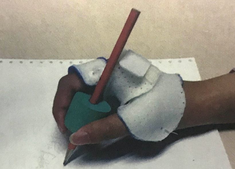 有关正中神经的损伤视频,周围神经损伤常见的康复问题