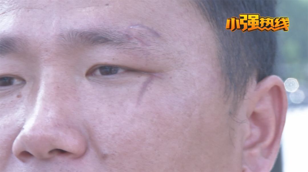 小米平衡车摔骨折保险赔多少,小米平衡车摔伤赔偿