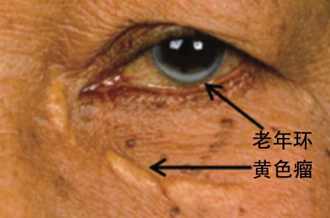 血管堵塞的三种面相,有这4种面相有福气