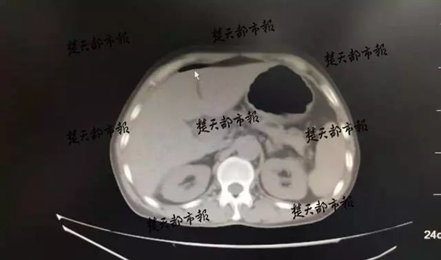 男子生吞一条活泥鳅险丢命,男子吃活泥鳅死亡