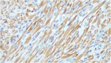 膀胱低级别肌纤维母细胞增生,膀胱纤维母细胞瘤