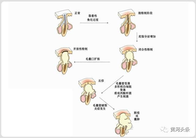 关注面子问题，只留青春不留痘