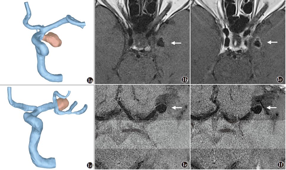 我是医生，假如我得了颅内动脉瘤，我会怎么办？