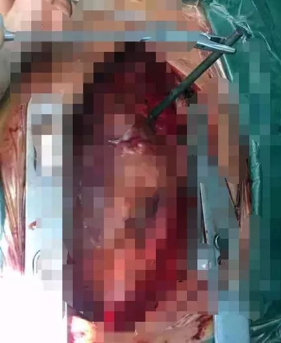 男子被钢钉射入体内5个洞,男子被钢钉刺入心脏里