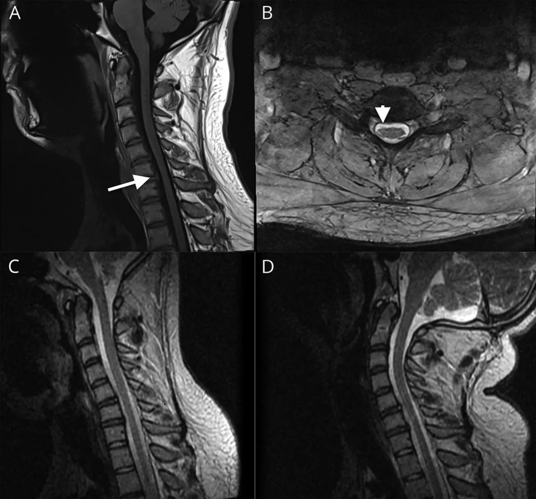 男性右手发麻无力是什么病征兆,35岁男性右手发抖警惕四种征兆