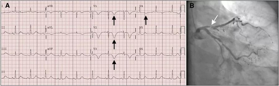 运动员t波改变怎么快速恢复正常,运动员会出现t波改变还能运动吗