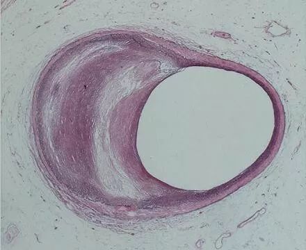 冠脉病变正性和负性重构,冠状动脉正向重构