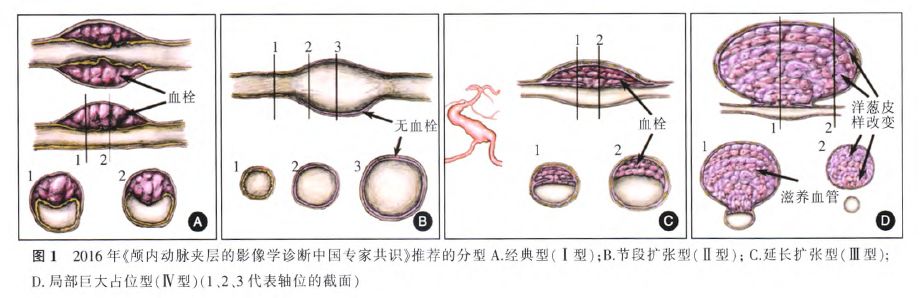 夜读：动脉的夹层，就仿佛是人生的夹缝