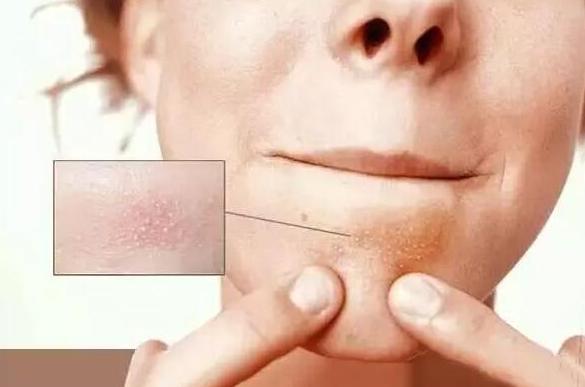 下巴螨虫白色小颗粒,下巴上有白皮屑
