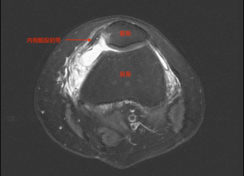 摔了一跤半月板二度撕裂,摔一跤膝盖半月板裂开了