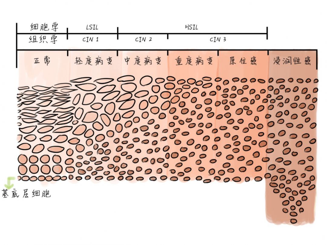 从hpv感染到原位癌得多长时间,从hpv感染发展到宫颈癌一般要多久