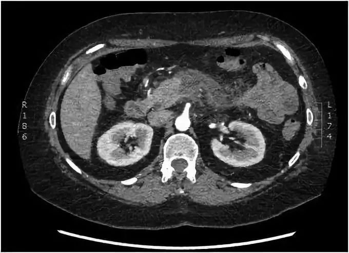结肠镜会诱发胰腺炎吗,肠镜诱发急性胰腺炎