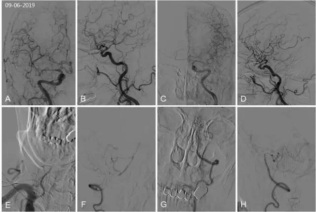 天坛周记·第147期｜右椎动脉V3-4段闭塞血管内介入治疗开通失败1例