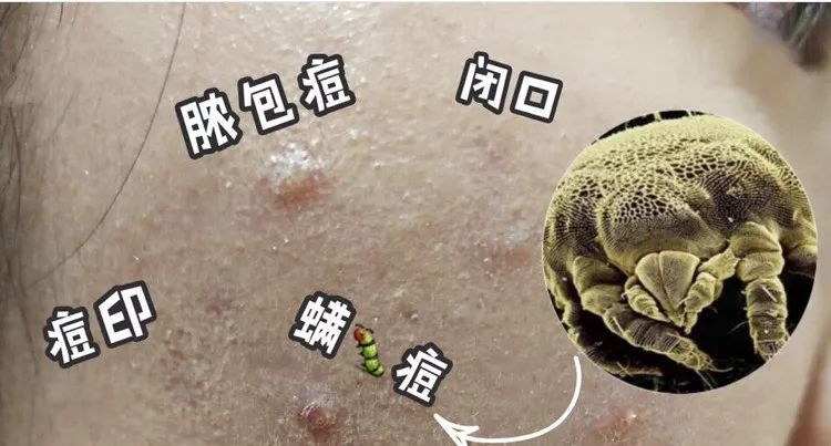 床上放个它，让螨虫绝望，让螨虫自杀，比太阳暴晒强1万倍